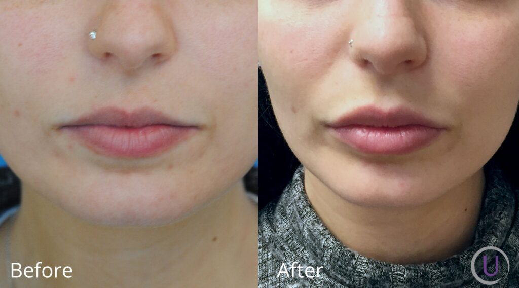 lip flip before and after