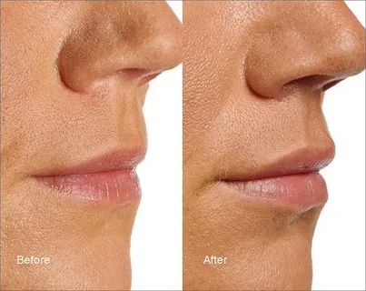 lip flip before and after
